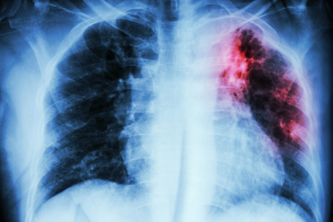 24 марта — Всемирный день борьбы с туберкулёзом